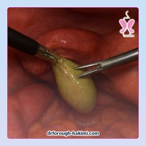 جراحی لاپاراسکوپی کیسه صفرا