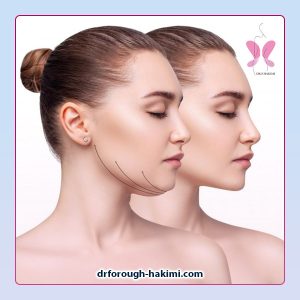 جراحی غبغب در اندیشه