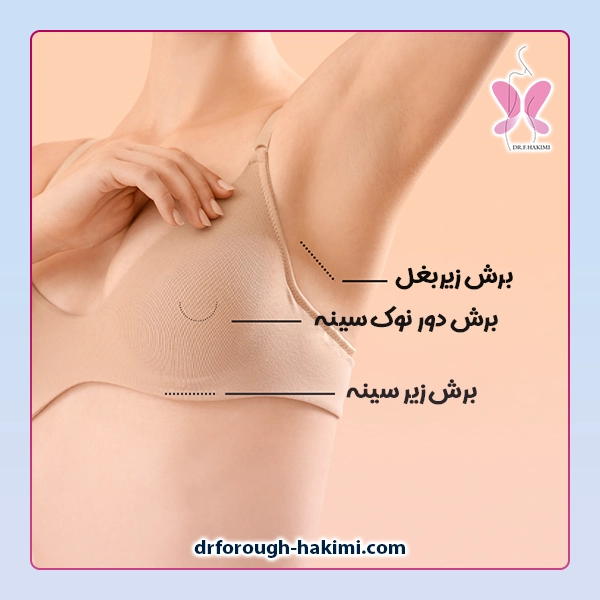 برش های پروتز سینه