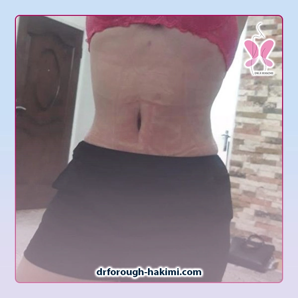 نمونه کار عمل ابدومینوپلاستی در شهریار