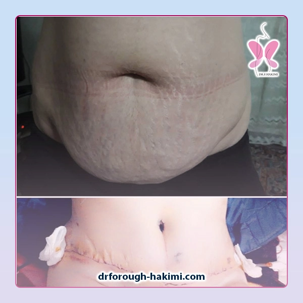 نمونه کار عمل ابدومینوپلاستی در شهریار