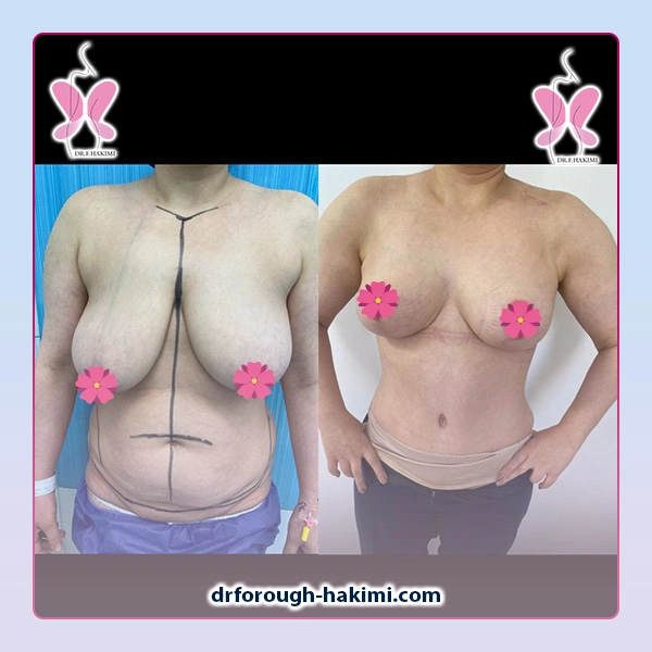 نمونه کار لیفت سینه در شهریار