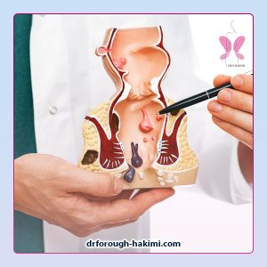 جراحی هموروئید در شهریار و اندیشه