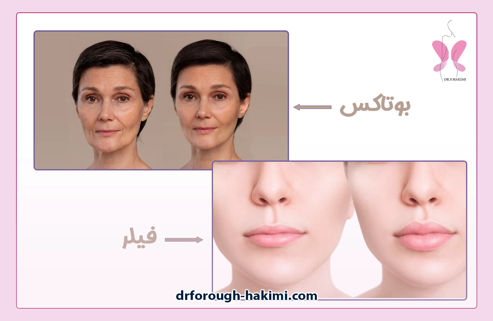 فرق تزریق فیلر با تزریق بوتاکس چیست؟