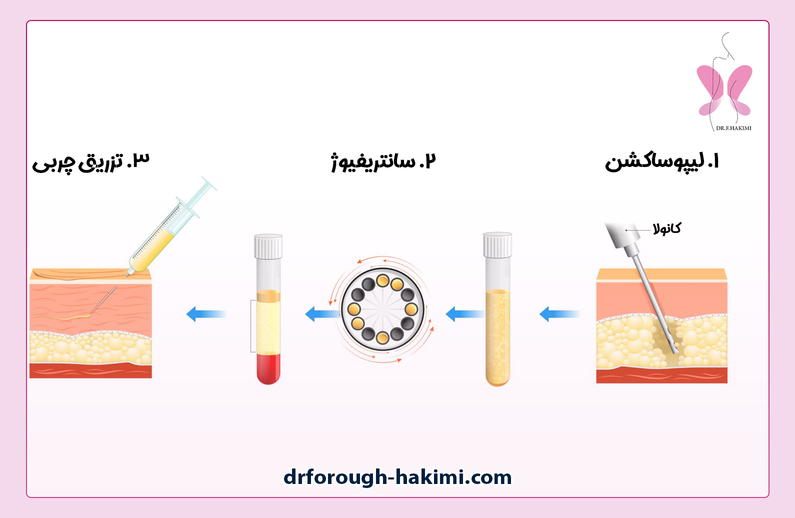 مراحل تزریق چربی