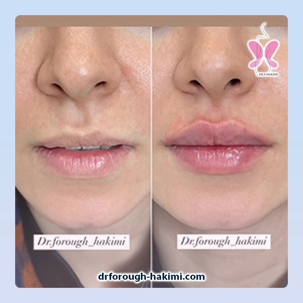 تزریق ژل در اندیشه