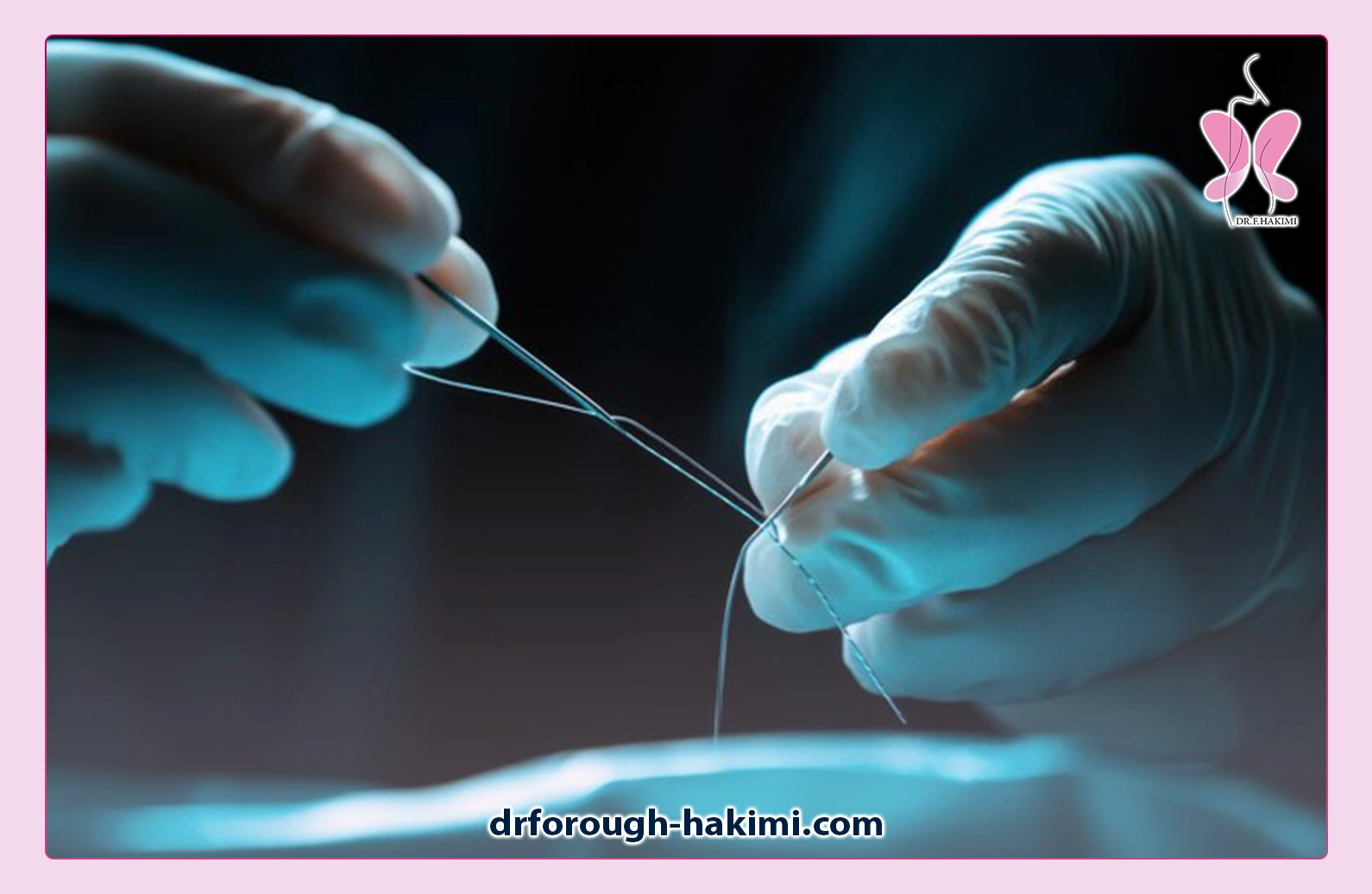 روند ترمیم بخیه ابدومینوپلاستی