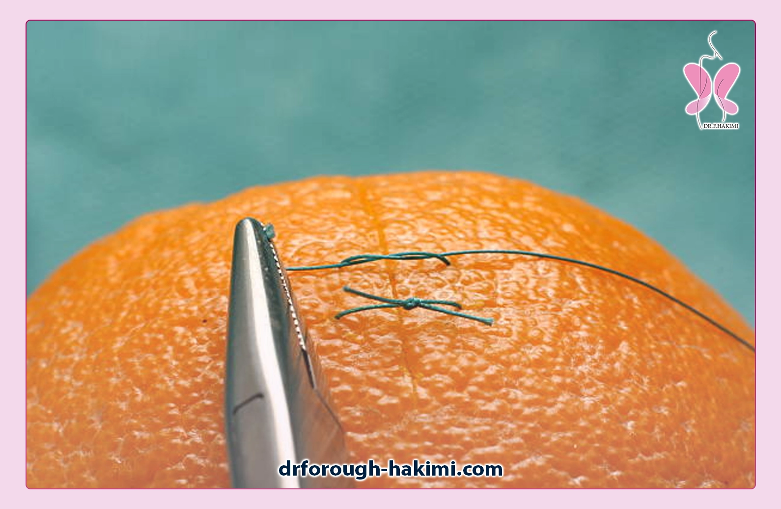 چه زمانی بخیه لابیاپلاستی می‌افتد؟