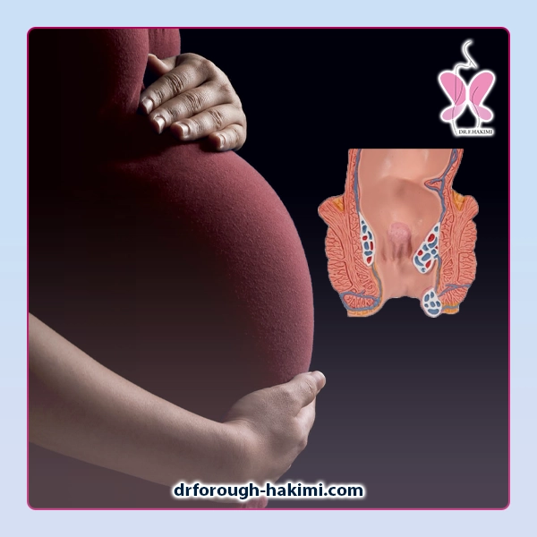 هموروئید در بارداری